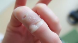 Mână cu deget umflat și vânăt, posibil bandajat.