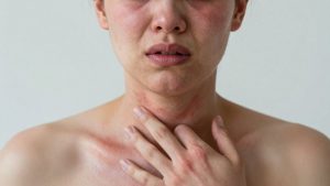 Persoană cu reacție alergică severă, față umflată și erupție.