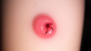 Umflătură roșie cauzată de înțepătura unui insect.